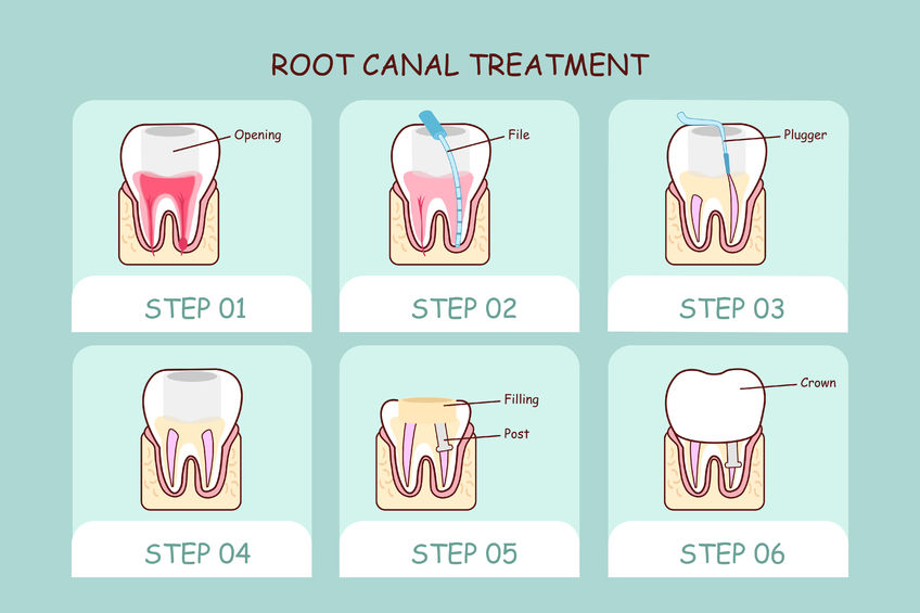 about Root Canal Treatment