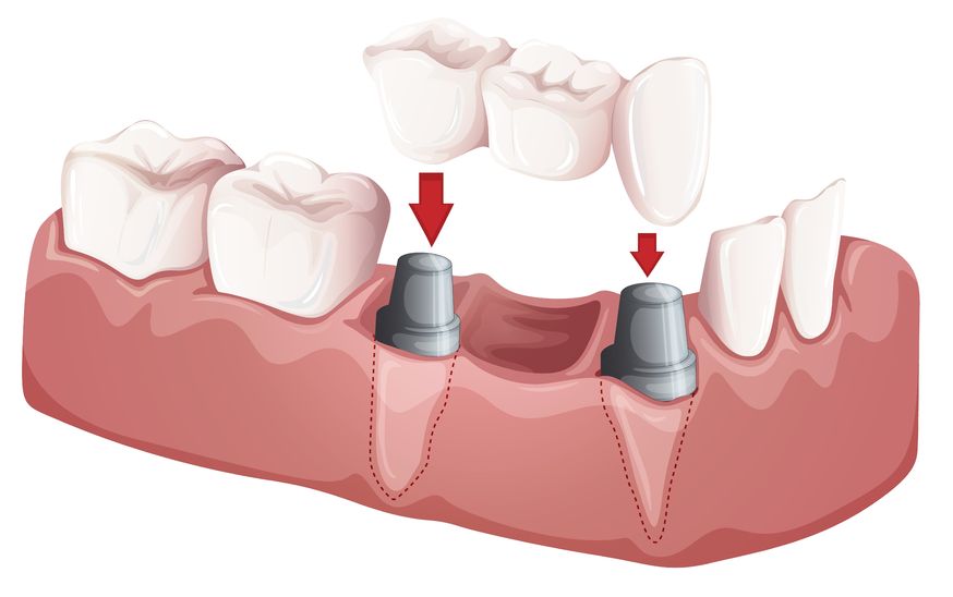 Dental Crowns & Bridges Taringa