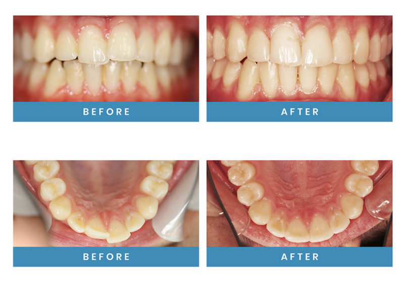 Invisalign Absolute Dental Care